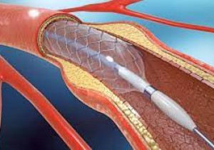 Thông báo về việc mời chào giá các mặt hàng Dây dẫn đường cho bóng và stent